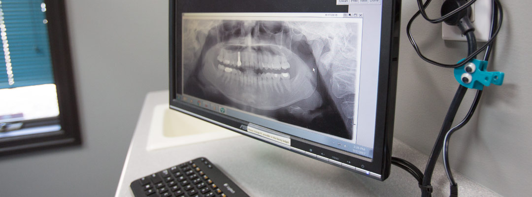 dental implants cedar rapids